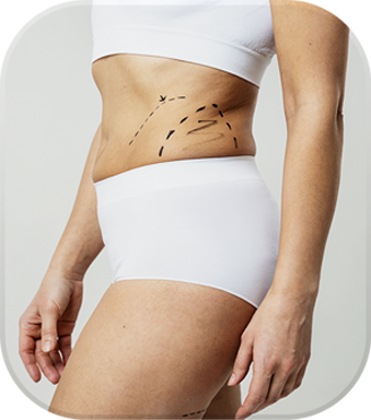Female showing hips with marker pen to represent liposuction