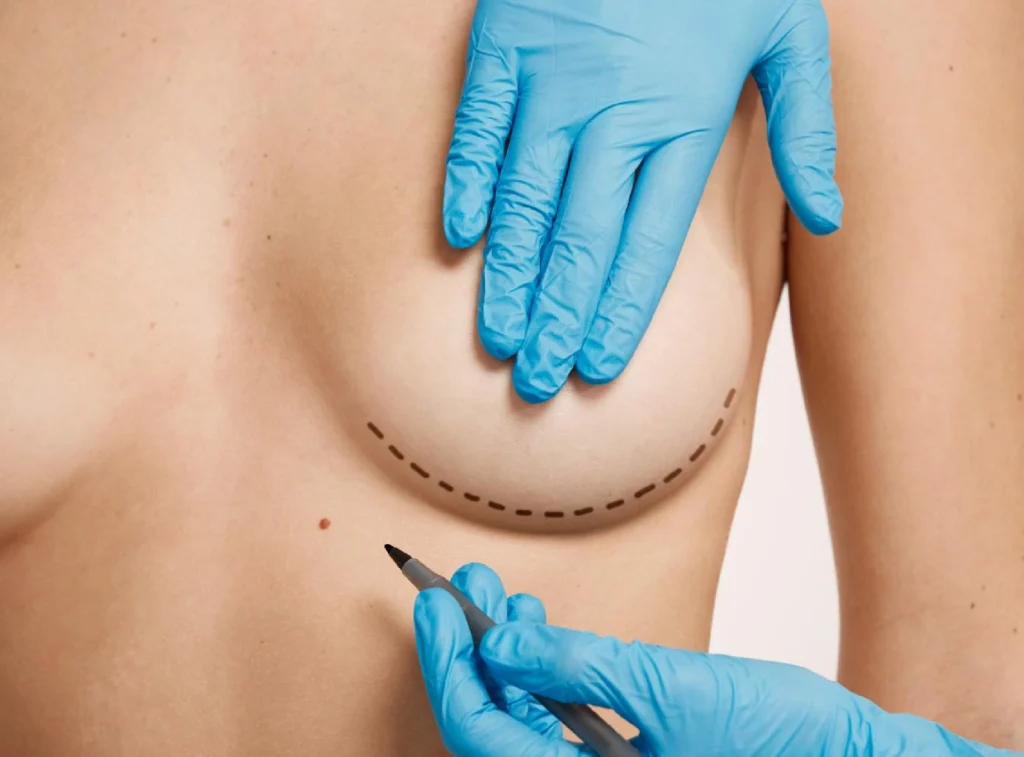 Breast lift