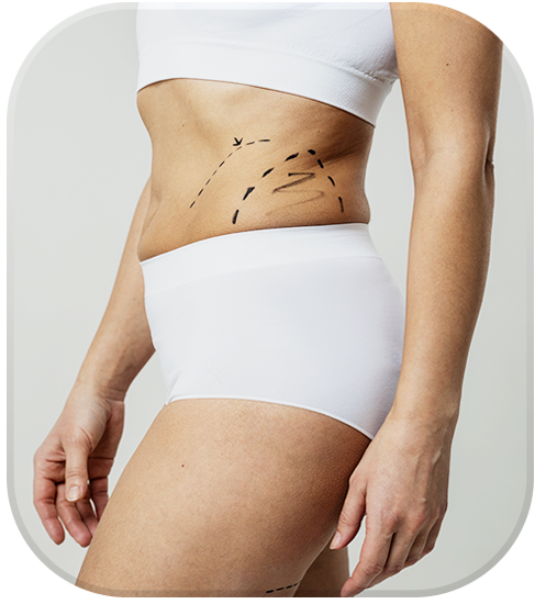 body liposuction