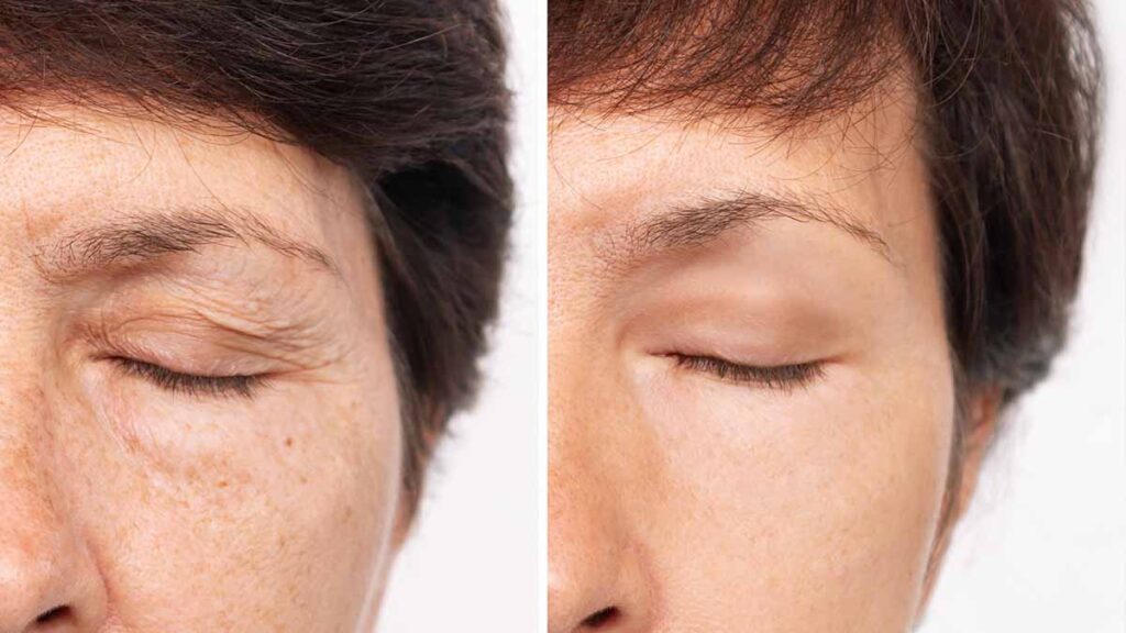 blepharoplasty