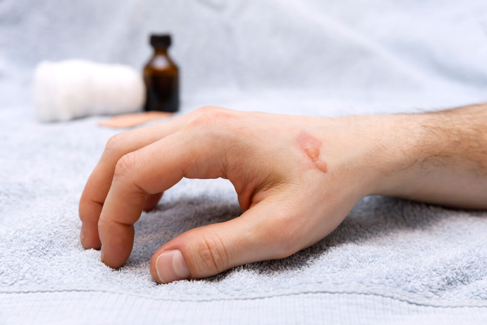 minor burn