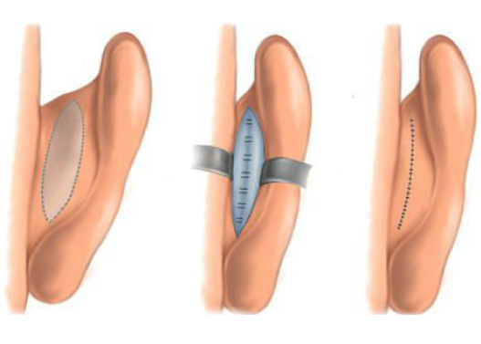 Otoplasty Ea Correction